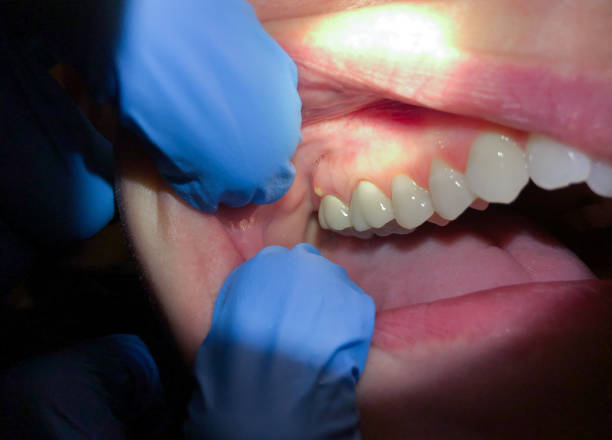 Best Emergency Tooth Extraction in Columbus, MS